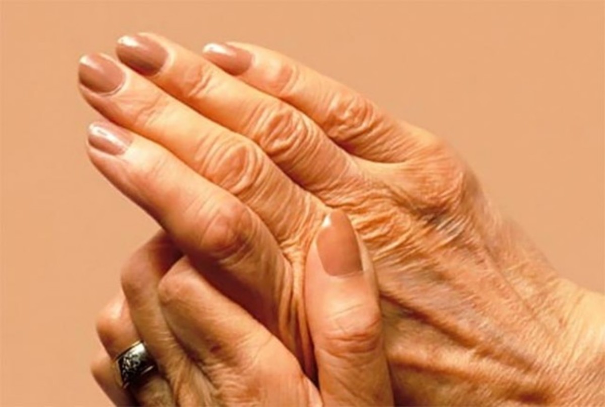 Артритные руки женщины фото