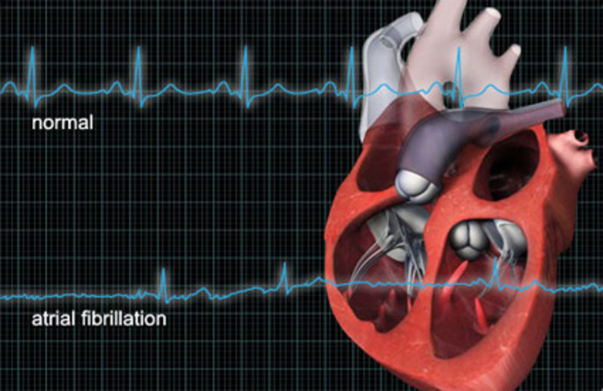 Аритмия сердца картинки
