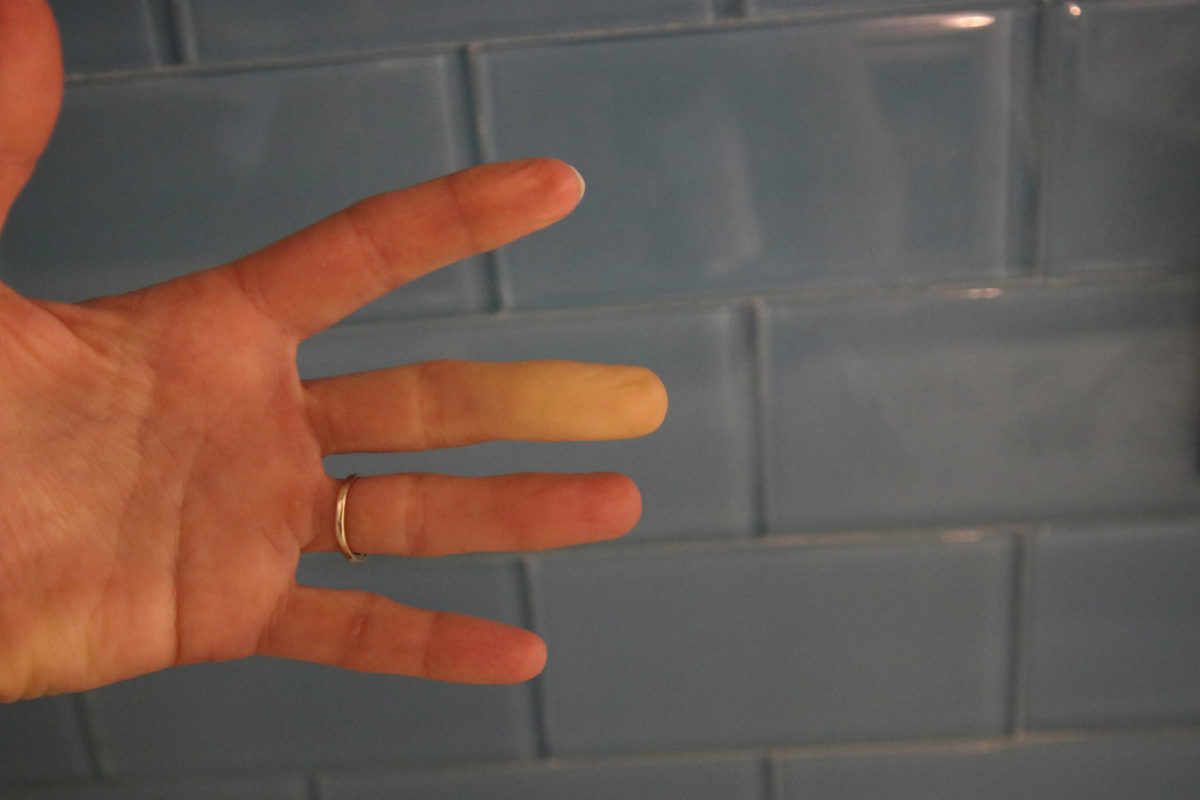 Φαινόμενο Raynaud