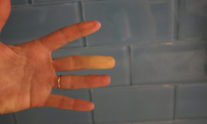 Φαινόμενο Raynaud